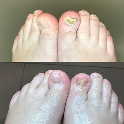 Experiență în utilizarea Promicil Cream Barnabas din Israel, fotografie înainte și după