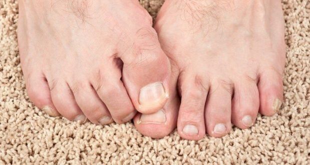 Simptomele ciupercii de unghii