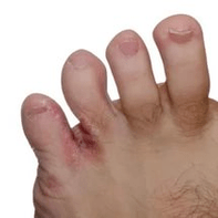 ciupercă între degete