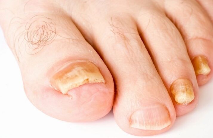 Ciuperca de pe degetul degetului