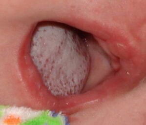 Localizarea bolii cu o ciupercă