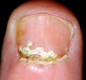 Simptome și semne ale bolii