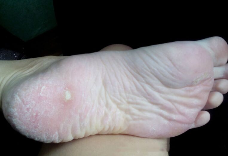 Tratamentul ciupercii cu un laser