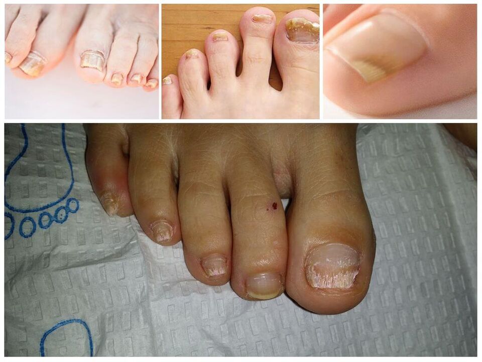 Boli fungice ale plăcilor de unghii