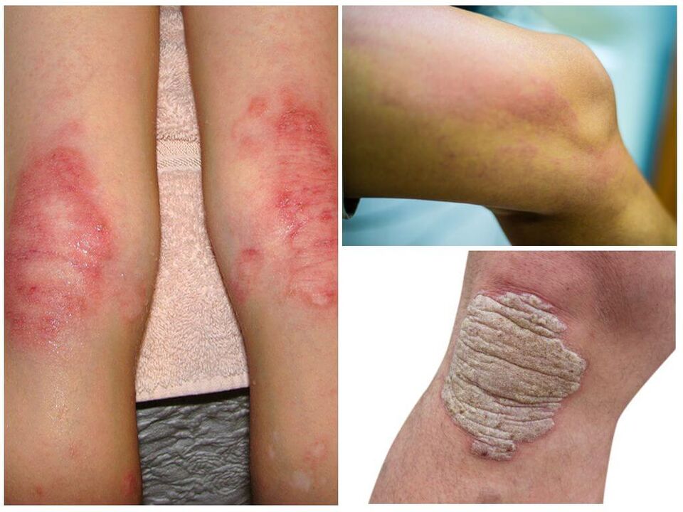 Infecții fungice ale genunchilor