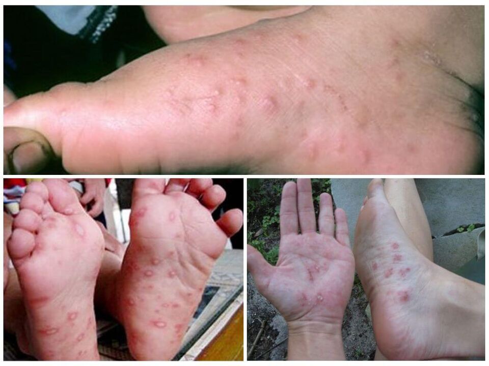 Leziuni hiperkeratotice ale picioarelor