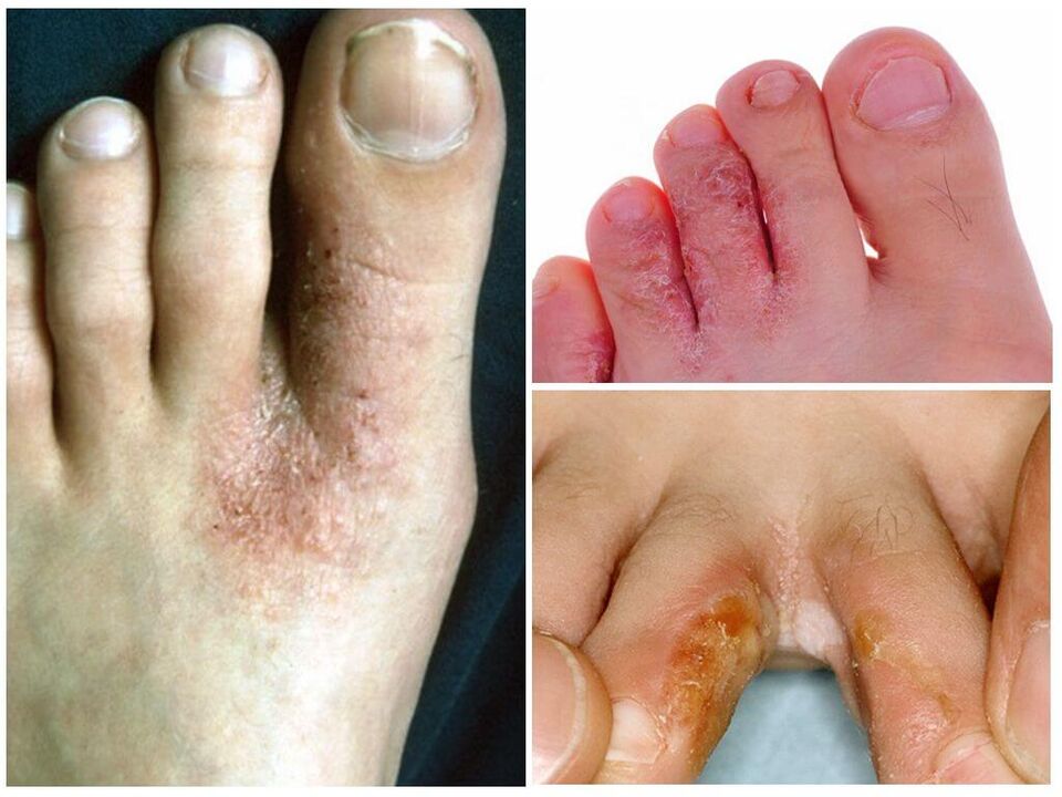 Micoza interdigitală