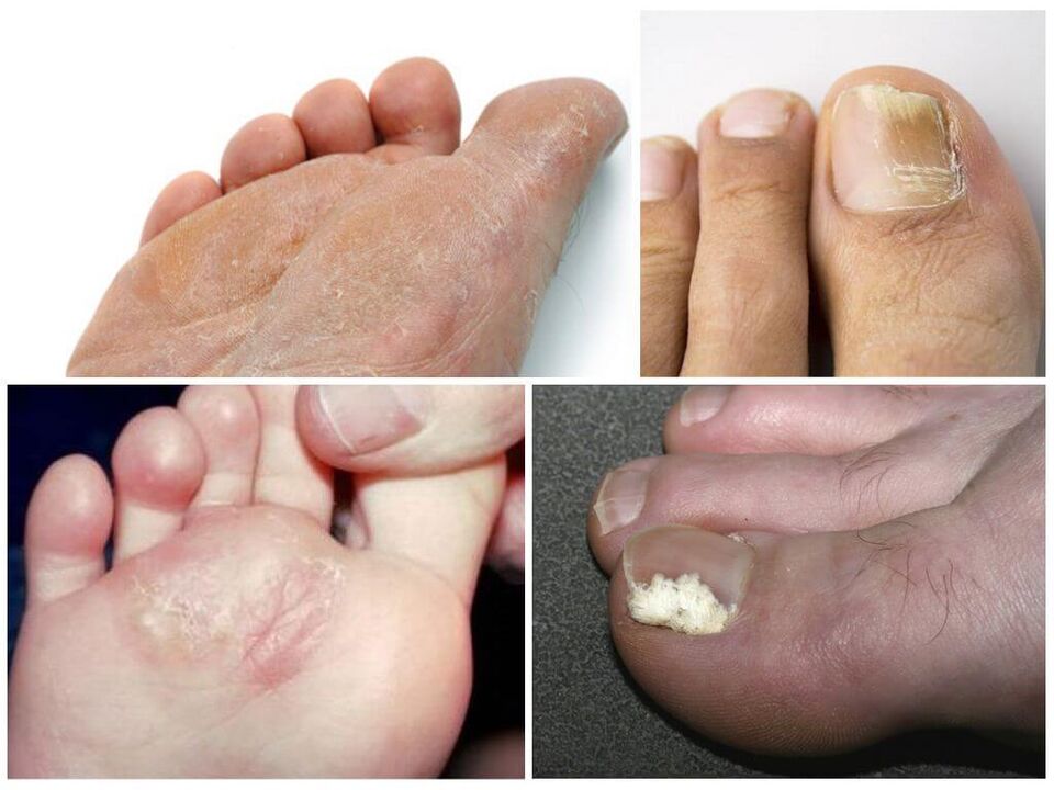 Stadiul inițial al ciupercii piciorului