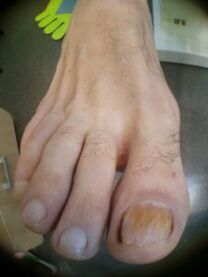 ciuperca degetului mare a unghiilor