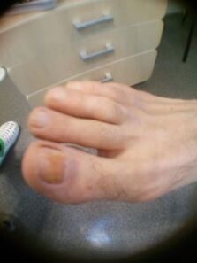 stadiu inițial al ciupercii unghiilor degetului mare