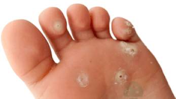 a doua etapă a infecției fungice