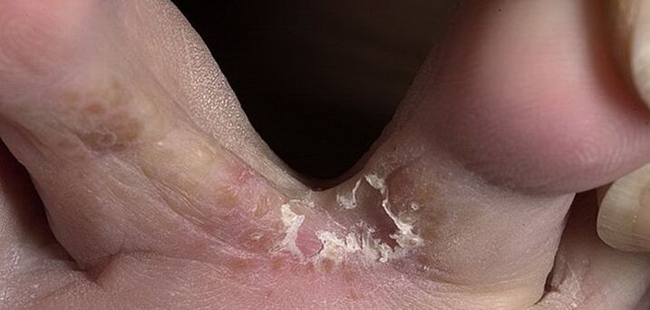 ciuperca între degetele de la picioare