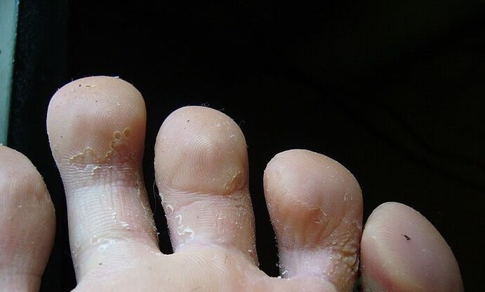 stadiul inițial al ciupercii