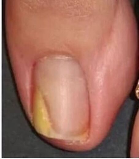 unghii cu ciuperci înainte de tratament