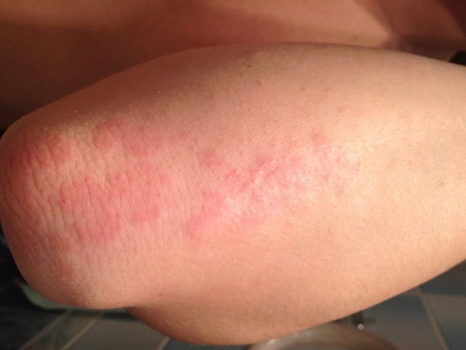 O reacție alergică sub formă de erupție pe pielea cotului după aplicarea unei picături de suc de celandină